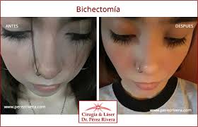 Bichectomia Cirugia Reductiva De Mejillas Como Bajar Los Cachetes Adelgazamiento De Rostro Adelgazamiento De Cara Reduccion De Mejillas Reducir Los Cachetes Reduccion De Cachetes Se realiza a traves de 2 pequeñas incisiones (1 cm cada una) por dentro de la boca a través de. reducir los cachetes