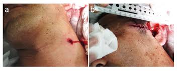 Instead, it missed his spine and exited through his stomach. Atypical Gunshot Injury To The Neck With An Unexpected Nonlinear Bullet Trajectory A Case Report And Review Of The Literature Research Square