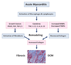 Myocarditis care at mayo clinic. Development Of Fibrosis And Dcm Following Acute Myocarditis Download Scientific Diagram