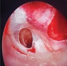 Image result for Myringosclerosis