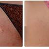 Laser hair removal in akron, oh | milan laser … since 1970 hairline hair loss treatment clinic in akron, ohio has prided itself on providing each client the highest level of service and expertise offered within our industry. 1