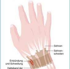 Bei einer sehnenscheidenentzündung hängt die therapie von der jeweiligen ursache ab. Uberbelastung Mit Der Pech Regel Gegen Sehnenscheidenentzundung Welt
