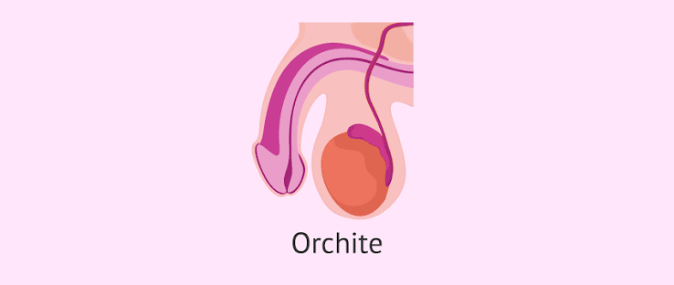 Orchites solution naturelle