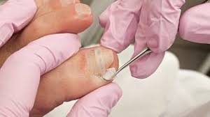 Image result for Akutní zánět nehtového lůžka