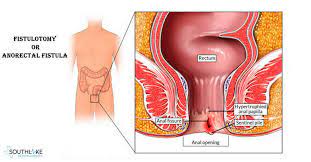 Fistula (plural fistulas or fistulae or fistulæ). Fistulotomy Anal Surgery Cause Diagnosis Treatment Of Anal Fistula