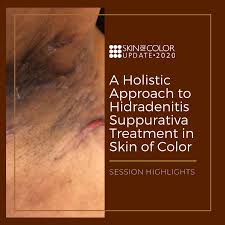 Hidradenitis is a lifelong problem that can be addressed with laser hair removal, biologic therapy, immune modulating therapy, surgery, and iit sc. A Holistic Approach To Hidradenitis Suppurativa Treatment In Skin Of Color Next Steps In Dermatology