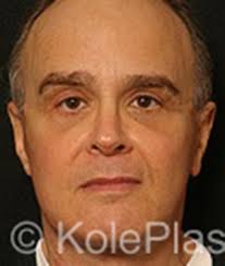 Plastic Surgery for Men