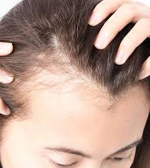 It also has fatty acids which gives deep nourishment to the hair. 10 Home Remedies To Regrow Hair On Bald Patches