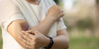 Image result for Contusion