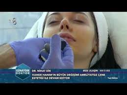 Ameliyatsiz Burun Estetigi Aquafilling Dolgu Dr Nihat Dik Guzellik Estetik Bursa