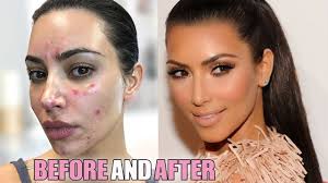 Apr 10, 2021 · kourtney kardashian's new boyfriend travis barker tattooed her name on his chest, but critics say the couple is moving too quickly.are they right? Kourtney Kardashian Plastic Surgery Is She Trying To Look Like Kim Youtube