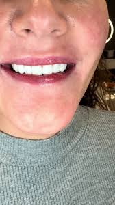 Understanding Dry Socket After Tooth Extraction