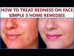 Breaking open your skin will make it red, angry, and potentially let bacteria into the area. How To Treat Redness On Face Simple 5 Home Remedies Youtube Redness On Face Face Redness Sunburn On Face
