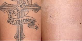 Several factors come into play when considering removing a tattoo. Step By Step Guide To Laser Tattoo Removal Laser Aesthetic Center