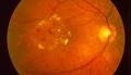 Nichtproliferative diabetische retinopathie