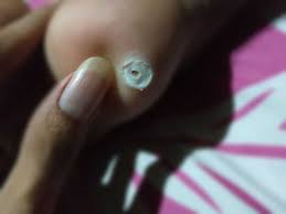 2 pcs pria pergelangan kaki pengaman pergelangan kaki pad penjepit pergelangan kaki olahraga pergelangan kaki dukungan untuk latihan angkat besi. Mata Ikan Cara Menghilangkan Tanpa Rasa Sakit Dan Bentuk Akar Jagad Id