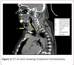 Anticipated Difficult Tracheostomy Should Ct Scan Be A Pre Requisite Insight Medical Publishing