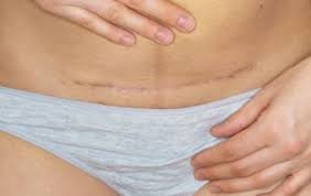 Saya mempunyai kelahiran normal selepas 3 minggu dengan jahitan luar saya menggunakan benang yang boleh digunakan sebagai daging.setelah terdapat benang benang yang digunakan yang tidak dislodged. Tolong Elak 10 Punca Luka Czer Terbuka Ini Doktor Kongsi 6 Tanda Luka Czer Bermasalah Pa Ma