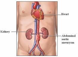 Aneurismas da aorta abdominal geralmente não apresentam sintomas, mas uma sensação pulsante no abdômen e / ou no dorso tem sido descrita. Aneurisma Aorta Abdominal Em Novo Hamburgo