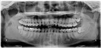 Wisdom Teeth Can I Keep Them Or Do They Need To Come Out