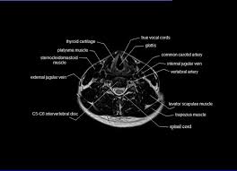 Mri Neck Anatomy Free Mri Axial Neck Cross Sectional Anatomy