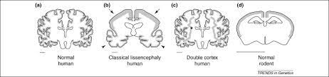 Genetic Mechanisms Underlying Abnormal Neuronal Migration In Classical Lissencephaly Trends In Genetics