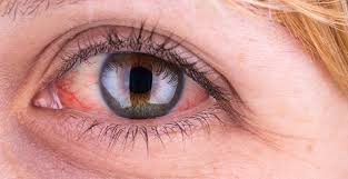 Mata merah terjadi ketika pembuluh darah kecil di permukaan mata membesar dan tersumbat oleh darah. Penyebab Dan Cara Mengatasi Mata Merah Tokopedia Blog