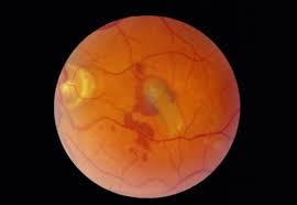 Retinal detachment is a serious condition which is caused when your retina, the layer of tissue at the back of your eye that processes light pulls away from the tissue around it. Retinal Detachment Eye Disorders Msd Manual Professional Edition
