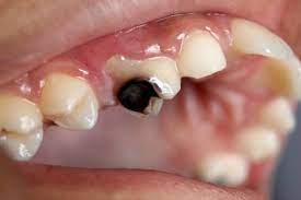 What Does A Cavity Look Like Signs Symptoms Family Friendly Dentist
