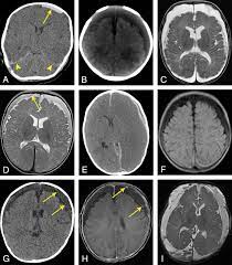 Understanding Subdural Collections In Pediatric Abusive Head Trauma American Journal Of Neuroradiology