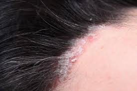 Image result for psoriasis