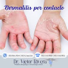 Image result for dermatitis contacta toxica