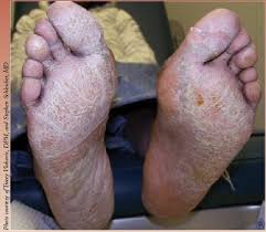 You can try them and maintain make sure to follow the instructions and remove the dead skin properly, if not it can lead to thick skin, formation of warts or corns on the feet. A Guide To Dry Skin Disorders In The Lower Extremity Podiatry Today