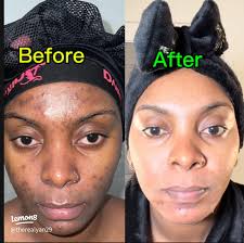 20 top Natural Skincare Before and After ideas in 2024