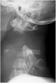 Image result for Spinal Trauma
