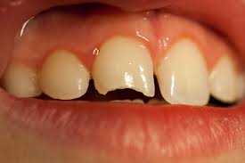 Image result for Tooth Fracture
