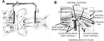 Check spelling or type a new query. Figure 3 From Reduction And Fixation Of Cranial Cervical Fracture Luxations Using Screws And Polymethylmethacrylate Pmma Cement A Distraction Technique Applied To The Base Of The Skull In Thirteen Dogs Semantic Scholar
