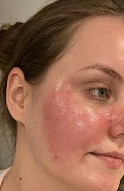 Applying hyaluronic acid irritates the skin : r/tretinoin