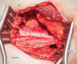 Thoracic Outlet Syndrome When Is Decompression Surgery Warranted Consult Qd
