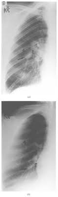 Having an abnormal backwards curvature of the spine. Https Www Clinicalradiologyonline Net Article S0009 9260 89 80119 9 Pdf