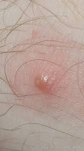 Exfoliate the affected area with a scrub or loofah while in the shower. Is This An Ingrown Hair Its On My Front Arm Above The Dividing Area Of My Elbow And Arm The White Part Seems To Be A Whitehead It Got Bigger Today When