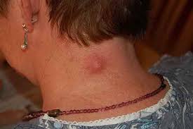Les boutons blancs et autres imperfections cutanées dont on se passerait bien. Abces Cutane Soigner Un Abces De La Peau