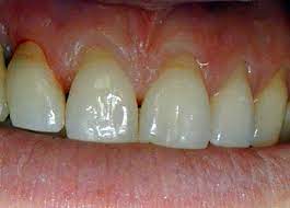 Zahnfleisch Entzundung Kann Die Ursache Fur Zahnfleisch Ruckgang Sein Es Gibt Behandlungen Und Zahnfleischtransplantationen Als Moglichkeit Der Therapie Dentalnews