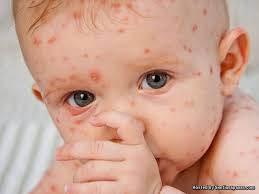 Get our printable guide for your next doctor's appointment to help you ask the right questions. Pemakanan Yang Sesuai Untuk Pesakit Chicken Pox Sentiasa Panas