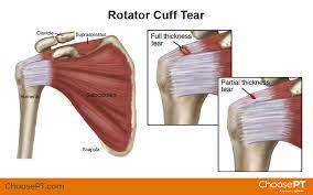 Guide | Physical Therapy Guide To Rotator Cuff Tear | Choose Pt