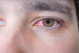 Blut Im Auge Ursachen Symptome Und Therapie Heilpraxis