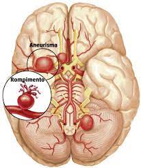 El aneurisma aparece como un saco relleno de sangre al lado de un vaso normal y unido a éste. Aneurisma Cerebral Que Es Tipos Sintomas Causas Secuelas Y Mas