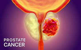 Prostate Cancer Awareness: Symptoms and Causes – DrDevonco
