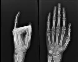 Mallet finger is the flexion deformity of the distal interphalangeal joint caused by separation of the extensor tendon from the distal phalanx. Mallet Finger Radiology Reference Article Radiopaedia Org