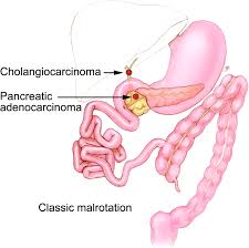 Image result for Intestinal Malrotation